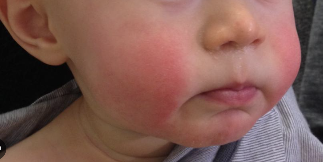 Slapped Cheek and Hand, Foot and Mouth Disease: What Parents Need to Know