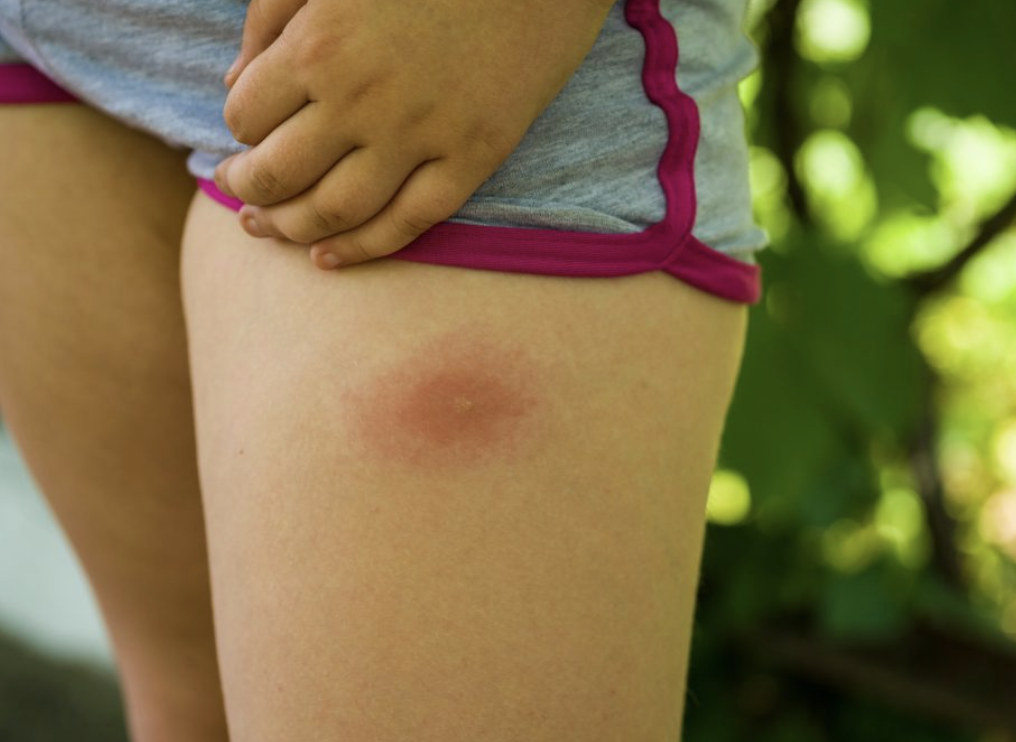 Tick Bites and Lyme Disease: What to Watch For This Spring