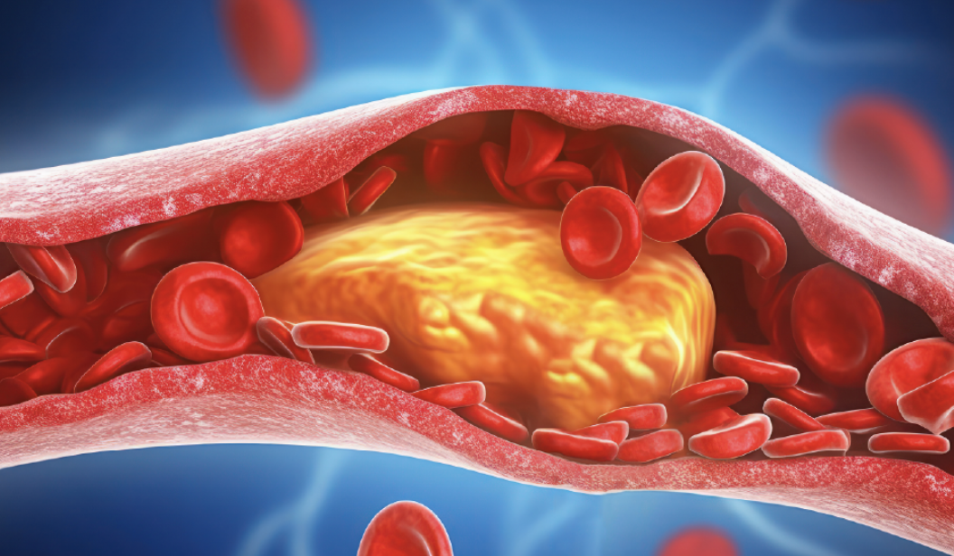 High Cholesterol: Symptoms, Risks, and How to Lower It Naturally