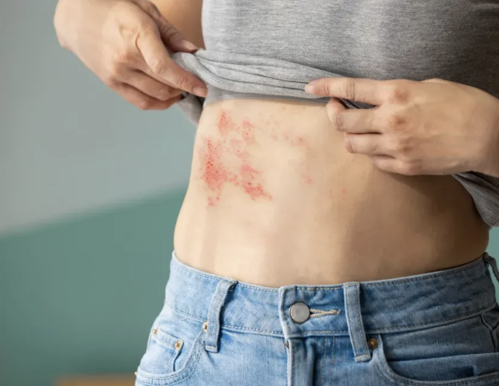 Shingles: Symptoms, Treatment, and How Your Pharmacy Can Help