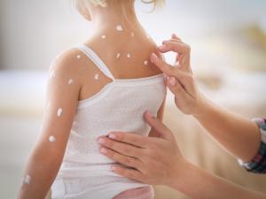 Chicken Pox Vaccine service picture